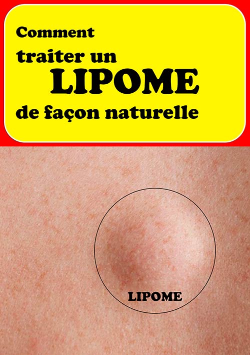 Lipome