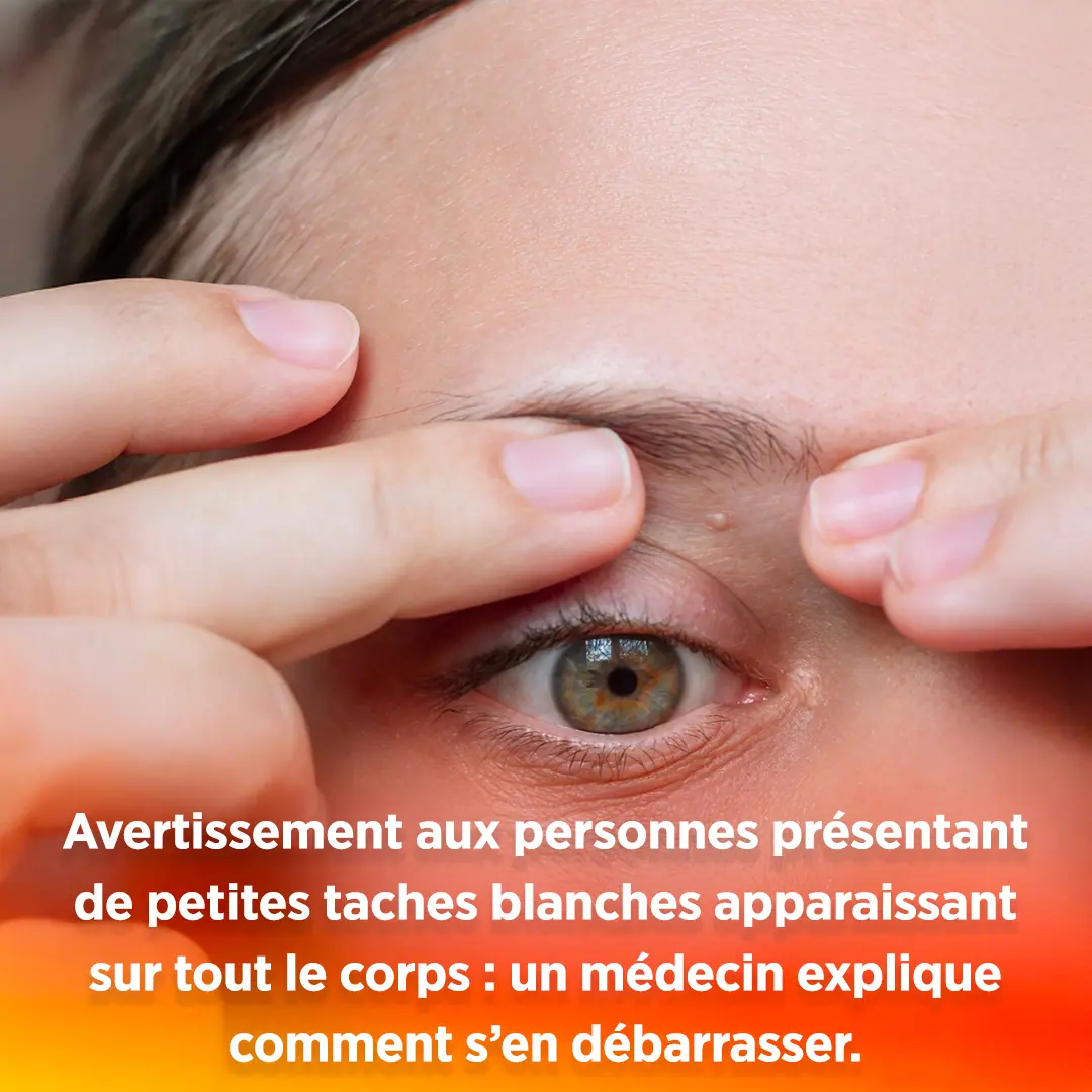 Avertissement aux personnes presentant de petites taches blanches apparaissant sur tout le corps un medecin explique comment sen debarrasser.jpg