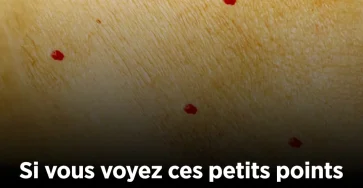 Si vous remarquez ces points rouges sur votre peau voici ce quils signifient 2.jpg