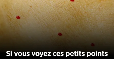 Si vous remarquez ces points rouges sur votre peau voici ce quils signifient 2.jpg