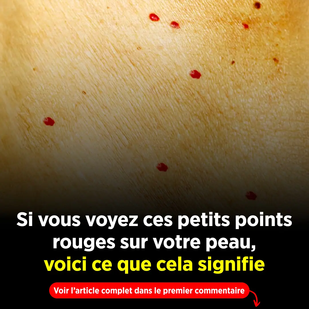 Si vous remarquez ces points rouges sur votre peau voici ce quils signifient 2.jpg