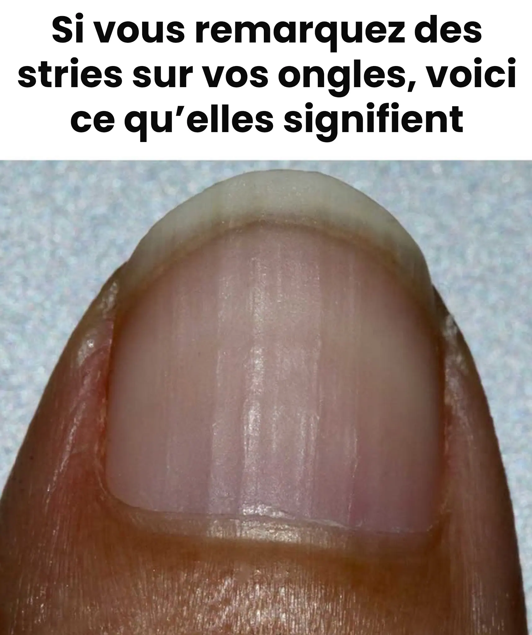 Si vous remarquez des stries sur vos ongles voici ce quelles signifient.jpg