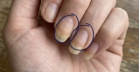 Si vous avez des stries sur vos ongles en voici la signification.jpg