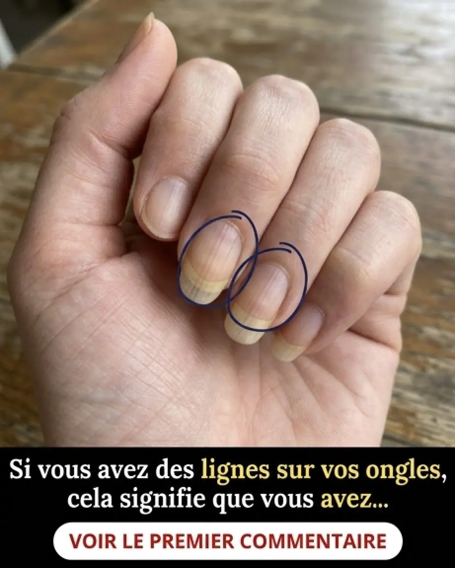 Si vous avez des stries sur vos ongles en voici la signification.jpg